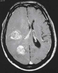 rétegfelvételezés (Computer Tomography, CT) Röntgen, kontrasztanyaggal javítva