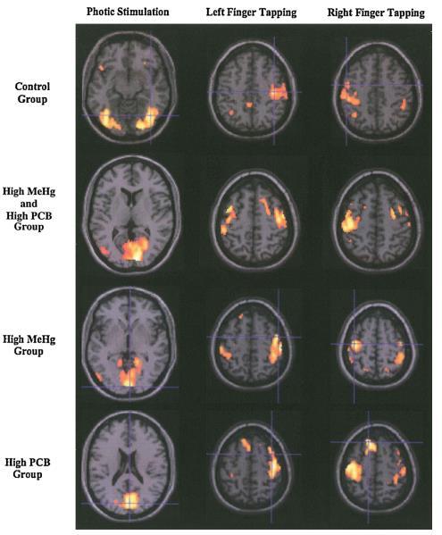 Funkcionális MRI (fmri)