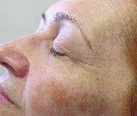 A Meso Peptide sorozatban azonban olyan 3 peptidre épülő szuper komplexeket alkottak, melyek az adott bőrproblémák gyökerére fókuszálva képesek a bőrtüneteket minél hatékonyabb módon mérsékelni.
