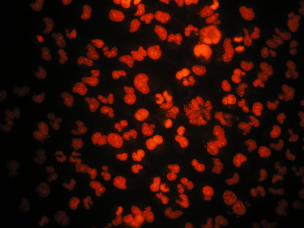 found! to! contain! many! cells! with! either! mul7ple! dis7nct! nuclei! or! large!polyblobed!nuclei!(yellow!