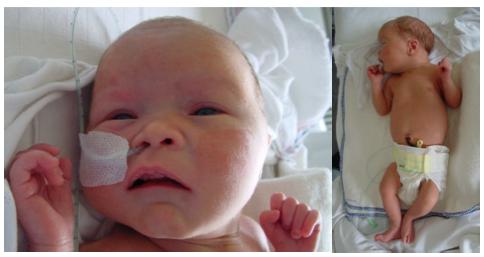 Supplementary,Figure,1.!Upper%panel:!Clinical!photographs!of!Perlman!syndrome! pa7ent! P4.1! showing! craniofacial! dysmorphisms!(everted! upper!