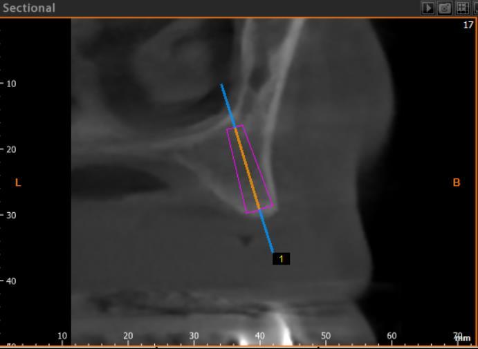 4 db Nobel Replace CC PMC implantátum 12, 15, 22,