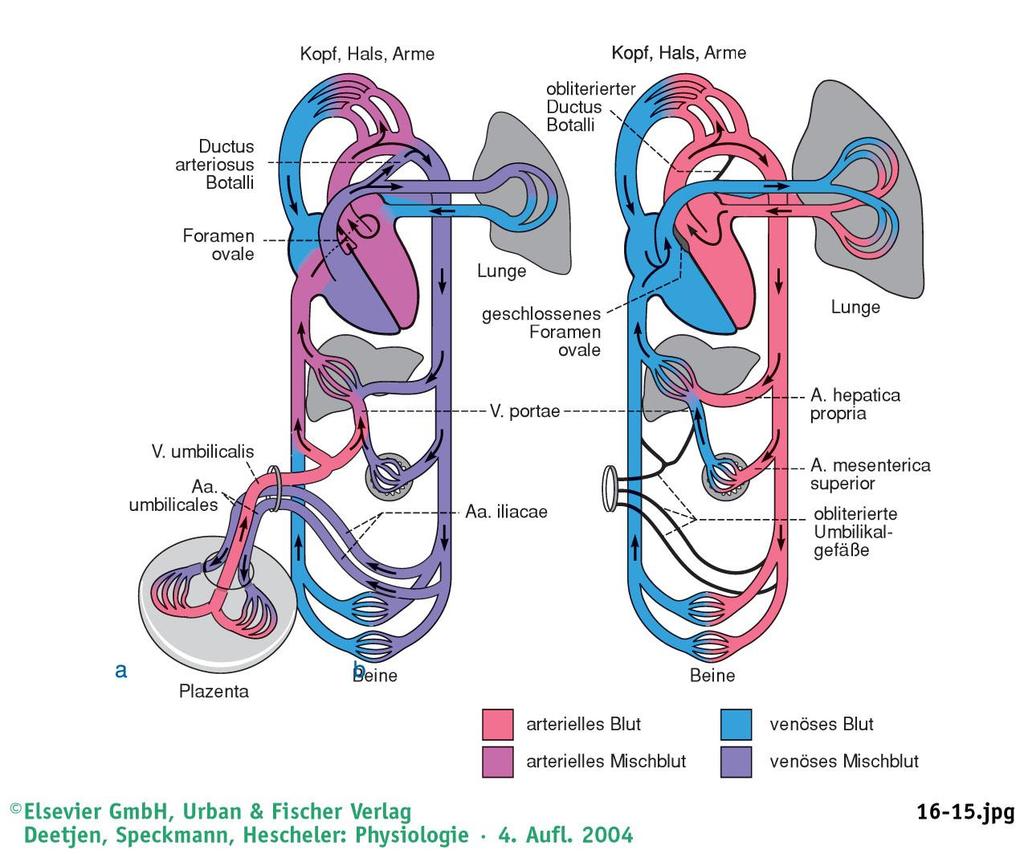 A keringés átrendeződése a születést követően előtt születés után A tüdőben a keringési ellenállás csökken. Ennek következtében megnő a tüdő felől a vénás visszaáramlás a bal szívfél irányába.