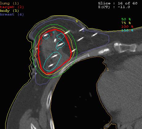 Eredmények 25. ábra: Konformális dóziseloszlás egy CT szeleten. A referenciaizodózisgörbe (vékony piros vonal) pontosan követi a céltérfogat kontúrját (vastag piros vonal).