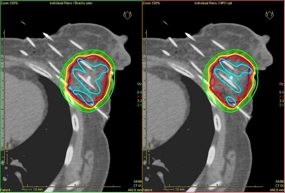 Eredmények 27. ábra: Hagyományos (bal) és inverz tervezéssel (jobb) készített besugárzási terv ugyanazon betegnél. A világoskék színű izodózisgörbék a 150%-os dózist mutatják.