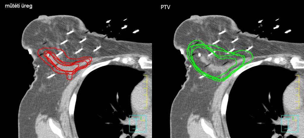 között a műtéti üreg és a PTV körberajzolásában a vizsgálat fázis 1 szakaszában [34]. A 28.