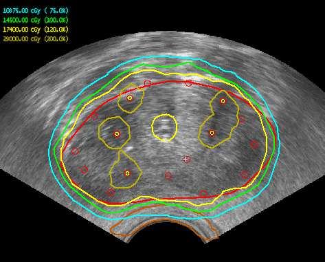 Eredmények 37. ábra: UH alapú intraoperatív és CT alapú posztimplantációs terv ugyanazon betegnél 30.