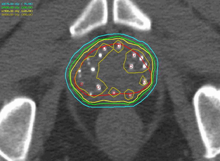 paraméterei (n=30) Intraoperatív Posztimplantációs p-érték V100 (%) 96 80 < 0,05 V90 (%) 98 86 < 0,05 V150 (%)