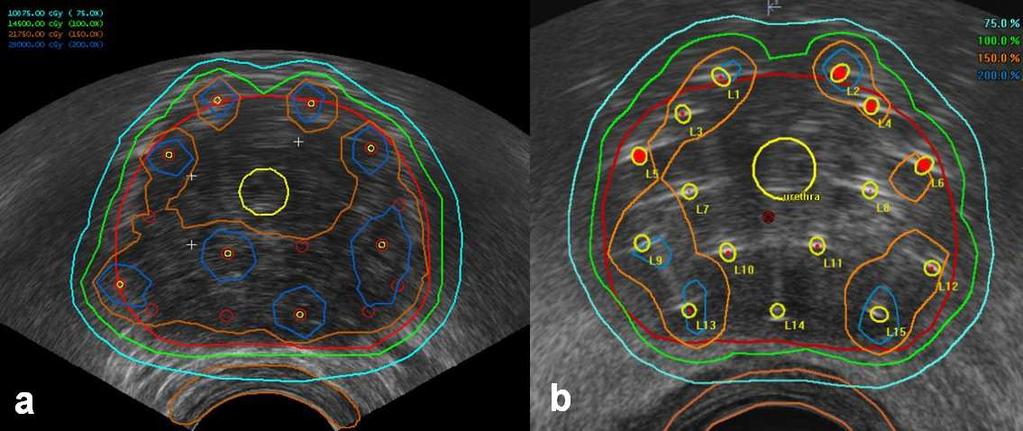 Eredmények 38. ábra: Reprezentatív dóziseloszlások transzverzális UH képen LDR (a) és HDR (b) technikával végzett prosztatűzdelésnél.