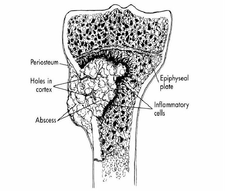 Haematogen fertőzés A baktérium embolus a metaphysis capillaris rendszerében akad meg Gyulladás Csontnecrosis, tályog