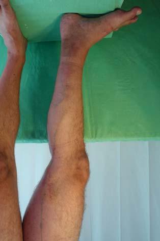 fore surgery. b. One week after glue intervention significant regression is visible. c. 3 weeks later superficial phlebitis developed in the middle third of the leg. d. Half a year later there is no visible varicosity.