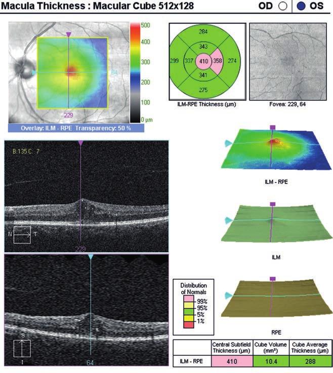 kezelése retina peeling diabetes