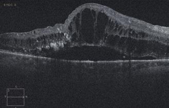 A neuroepithelium elemelkedett, nasalisan nagy cisztoid űrök, temporálisan kemény exsudatumok észlelhető, temporálisan a neuroepithelium szerkezete elmosódott.