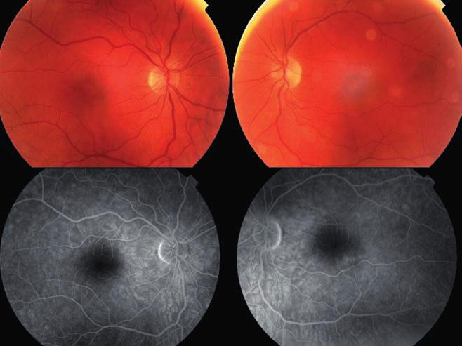 Is the Chloroquine-premaculopathy reversible? 1. ábra: Példa a Delagil leállítása után progrediáló és stagnáló látótérre.