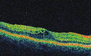 Felnőttkorban diagnosztizált Coats-betegség 4. ábra: Az 1. beteg macula OCT-felvételén elsimult foveolaris be - nyomatot, cisztoid ma - cu la ödé mát láthatunk mális tartományban (15/14 Hgmm) mértük.