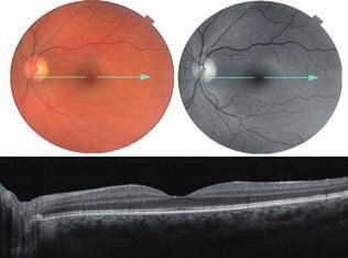 ábra: A kezelést követően 22 hónappal spectral-domain OCT készült. Komplikáció nincs, a membrano to - miás nyílások nem láthatóak, a fundus kornak megfelelő visszaáramlást a jobb szívfélbe.
