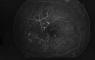 Management of diabetic macular edema 3. ábra: Iszkémiás maculopathia.
