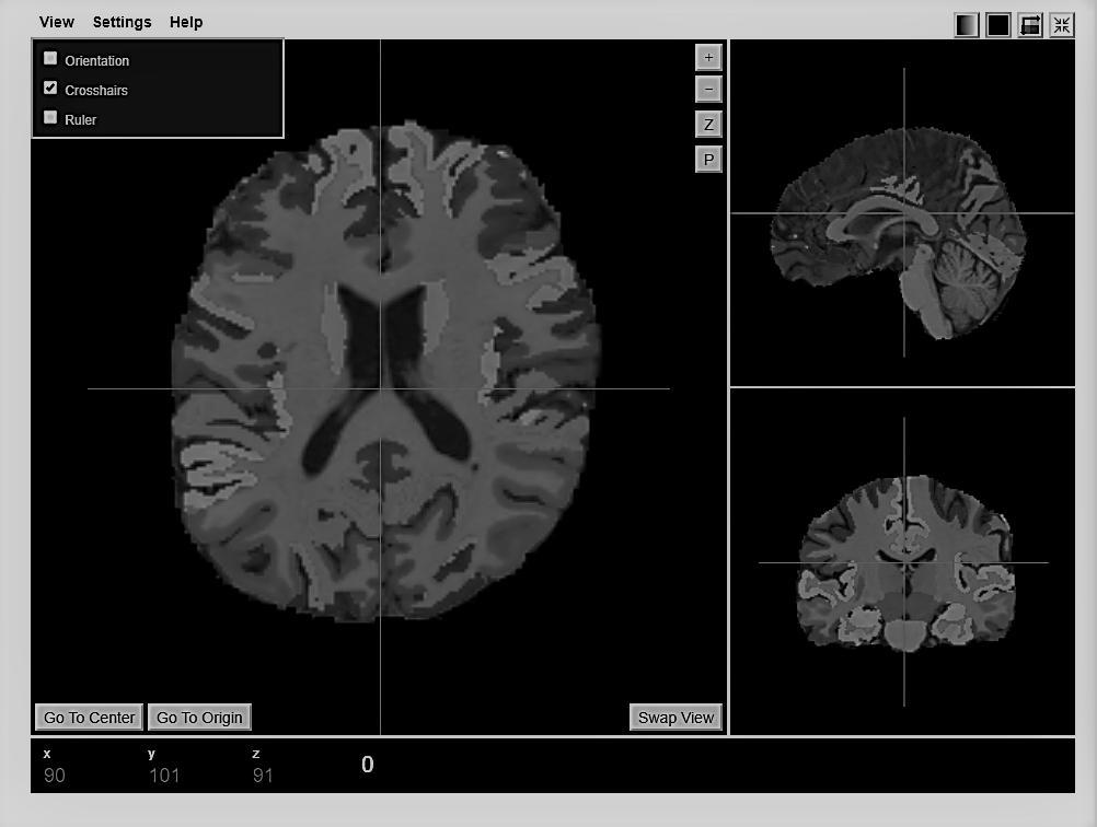 Funkcionális konnektóm és a konnektivitási mátrix meghatározásával [7] olyan neurodegeneratív betegségek diagnosztizálhatók, mint az Alzheimerkór vagy a Parkinson kór.