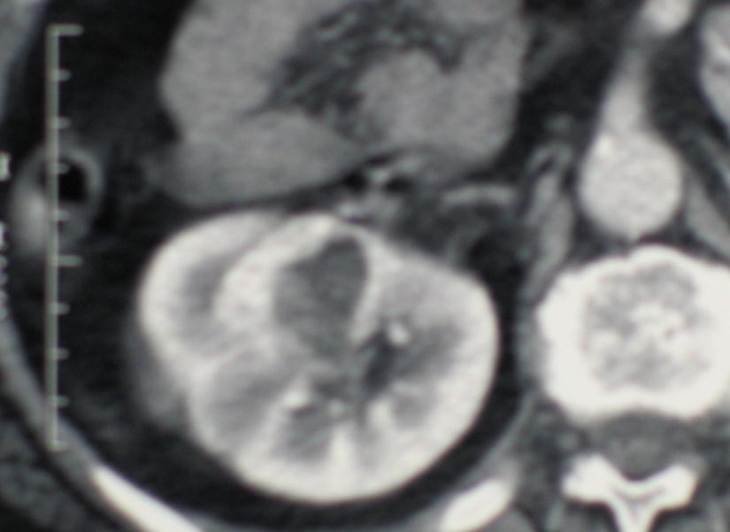 Follow- up No enhancement on CT?? No growth (long follow- up needed)?