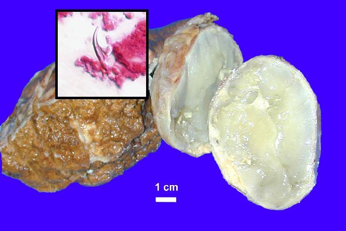 Ecchinococcus cysta a betét a