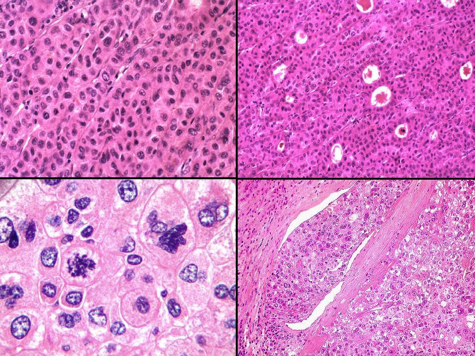 A HCC különböző hisztológiai formái HCC, trabecularis forma HCC,