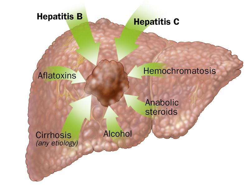 HCC és CC The most common hepatic malignancy and is the leading cause of mortality in patients with