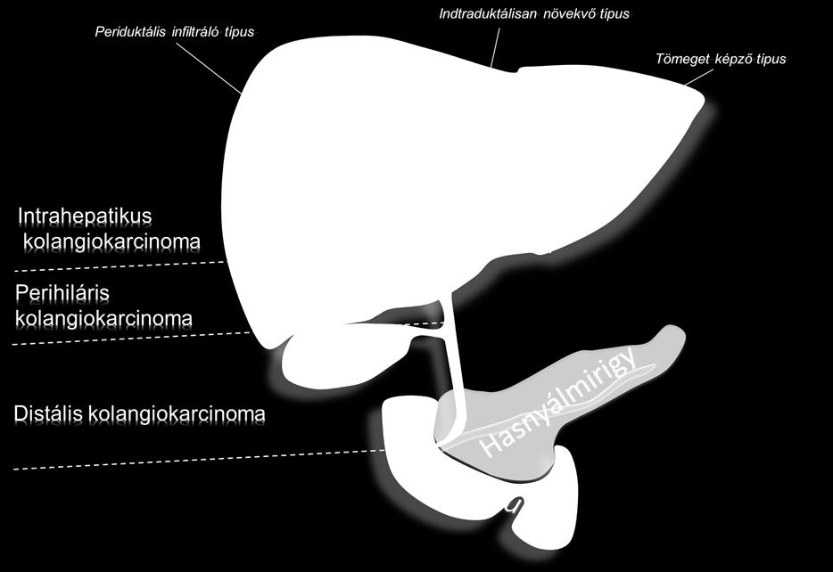 biliary tract malignancy Although it is more common in Asia, its incidence in Europe and North America