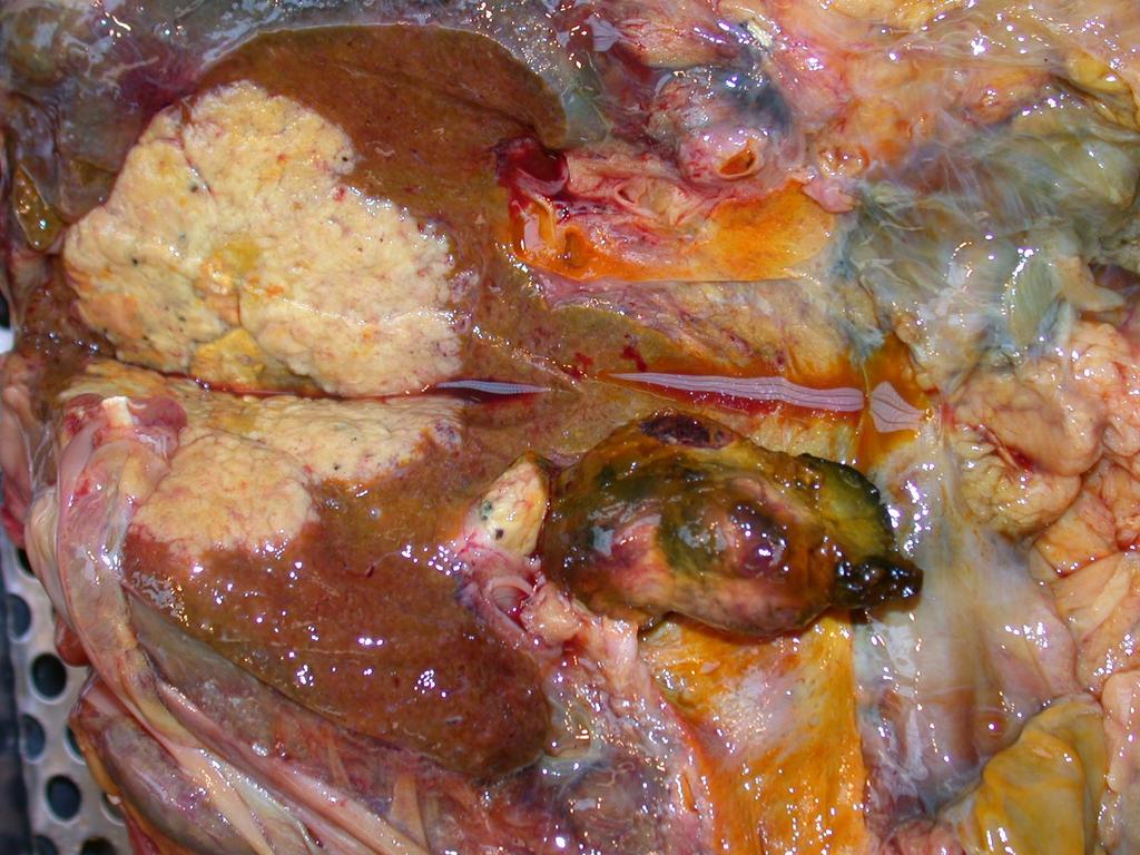 Cholangiocarcinoma Nagy tumor a