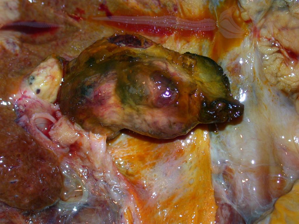 Cholangiocarcinoma Tumor, mely kinőtt