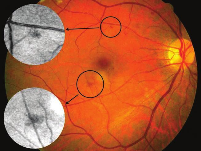 The Operation of Reading Centers for the Standardized Analysis of Ophthalmic Images Aszemfenék (fundus) fotódokumentációjának igénye napjainkra jelentős mértékben megnőtt.