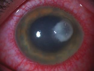 Bacterial keratitis 5. KÓROKOZÓK A bakteriális keratitist okozó baktériumokat a napi gyakorlatban legtöbbször a Gram-festés eredménye alapján csoportosítjuk.
