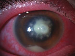 Bakteriális keratitis 7. ábra: Nagy méretű, uvea előeséssel járó perforált ulcus korábbi keratoplasztika után 4.
