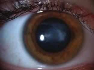 Szemhéjak hegei, szemhéjzárás elégtelensége (lagophthalmus) Alsó könnypont-kifordulás Entropium, Ectropium Conjunctiva Váladékozás, Conjunctivis jelei (belövelltség, papilla, folliculus,