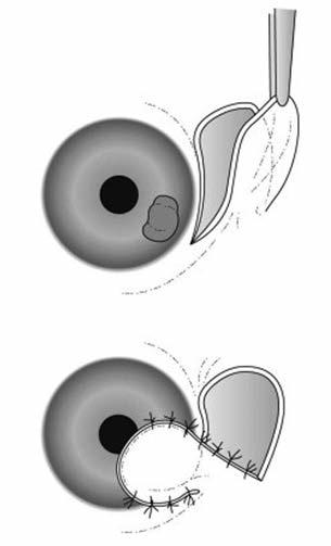 Bacterial keratitis 15. ábra: Monopedun - cularis lebeny használata perifériás folyamat esetén (11) 16. ábra: Bipeduncu la - ris (híd) lebeny használata centrális folyamat esetén (11) 8.2.