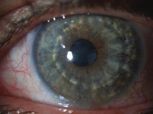 Ideális esetben a műtétet már halvány, békés szemen végezzük, legtöbbször a centrumot is érintő, visust rontó hegesedés és a cornea elvékonyodása miatt (optikai kera - toplasztika).