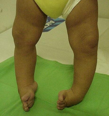 2. A VELESZÜLETETT DONGALÁB ORVOSTUDOMÁNYI HÁTTÉRISMERETEI A veleszületett dongaláb (pes equinovarus congenitus) a láb leggyakoribb veleszületett fejlődési rendellenessége, amelyet a láb jellegzetes