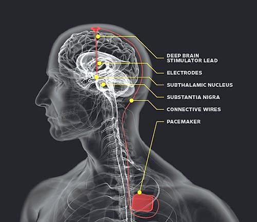 Size: Weight: Battery: 54 mm x 54 mm x 9 mm 40 g rechargeabel Specifiations for Activa RC Deep Brain Neurostimulator Model 37612 Battery life: 9 years Stimulation parameters: Pulse rate: 2-250 Hz