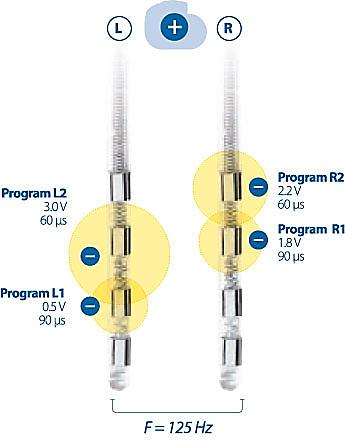 PROGRAMMING OF ACTIVA RC Two pulses with different combinations of active electrodes, amplitudes and pulse widths can be programmed for each lead.