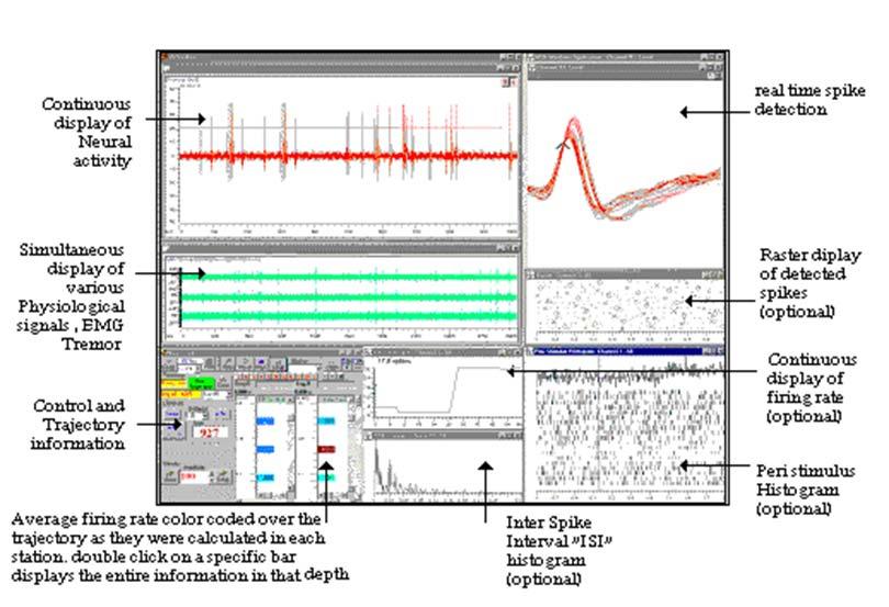 ELECTROPHYSIOLOGICAL GUIDANCE SYSTEM FOR TARGET LOCALIZATION This essential step allows the observation of beneficial effects (improvement of PD symptoms) inside the target and of side effects