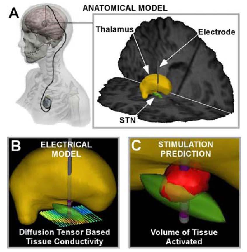 PRINCIPLE OF MODELING OF DBS Butson et al.