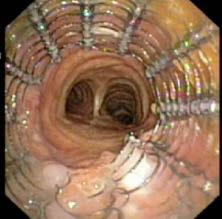 STENT TÍPUSOK: EGYENES ÖNTÁGULÓ FÉMSETNEK. Részlegesen fedett Ultraflex stent : FDA : csak akkor használható, ha egyéb kezelési lehetőség nincs (műtét vagy silicone stent) Lund et al.