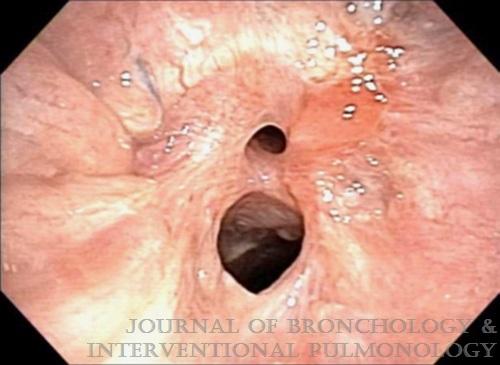 Clinical Success Stenting Distal Bronchi for Lobar Salvage in Bronchial Stenosis Sethi, Gildea,Almeida, Cicenia, Machuzak J Bronchol Inervent Pulmonol Volume 25,