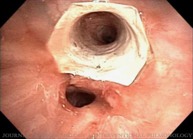 Clinical Success Stenting Distal Bronchi for