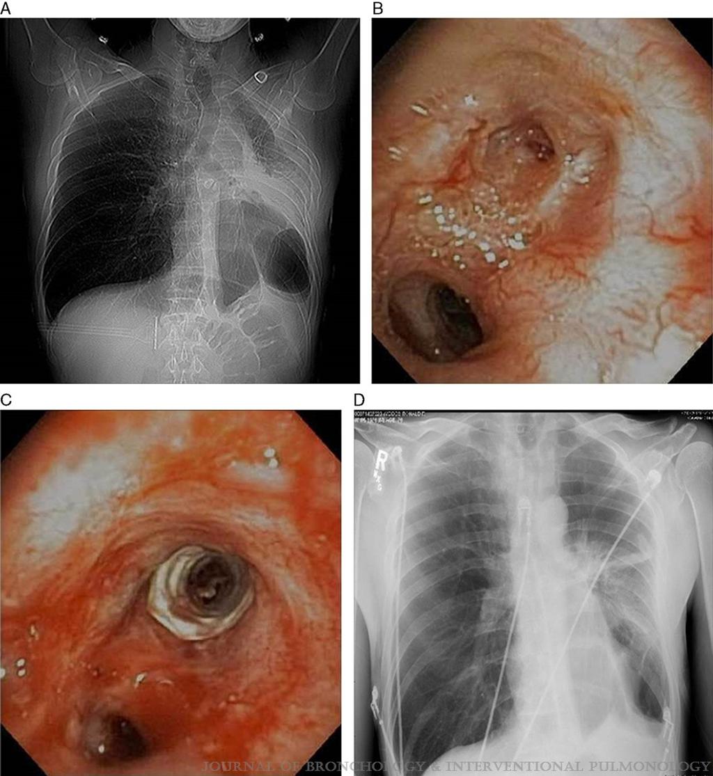 Clinical Success Stenting Distal Bronchi for Lobar Salvage in Bronchial Stenosis Sethi, Gildea,Almeida, Cicenia, Machuzak J Bronchol Inervent Pulmonol Volume 25, Number 1,
