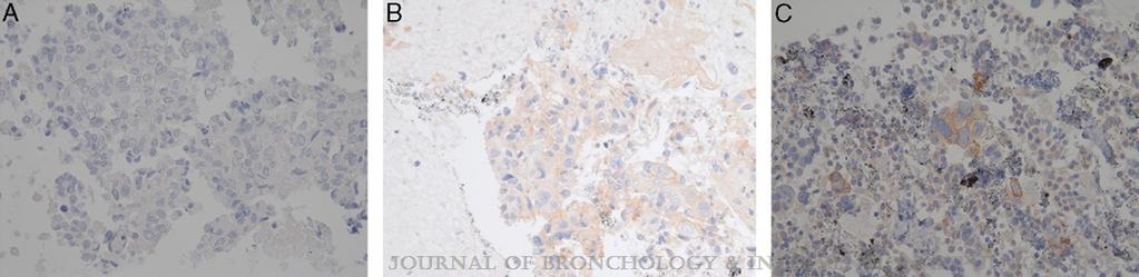 The Use of Endobronchial Ultasound-guided Transbronchial Needle Aspiration Cytology Specimens for Programmed Death Ligand 1 Immunohistochemistry Testing in Non-Small Cell Lung Cancer Sean Stoy,