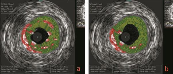 Figure 2. Virtual histology intravascular ultrasonography images. (a) Image before combined treatment with ezetimibe + rosuvastatin.