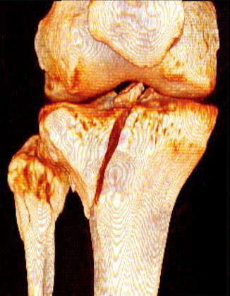 Tibia lateralis