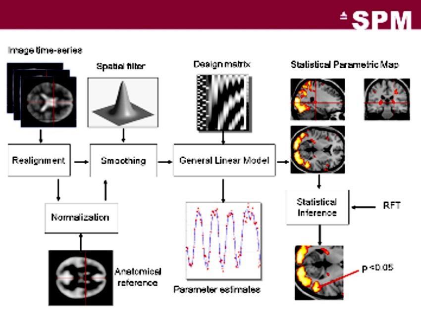 Friston, Statistical Parametric Mapping (SPM) az agyi