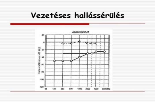 Ez köszönhető a digitális, nagyteljesítményű hallókészülékeknek; a korai fejlesztés kibontakozásának; a komputertechnika térhódításának a diagnosztizálásában és a terápiában; illetve a cochleáris