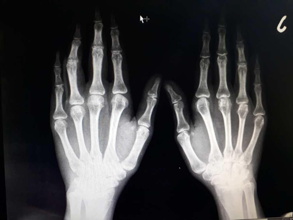4.2. Betegvizsgálatok Szakdolgozatom ezen szakaszában kiválasztottam 10 rheumatoid arthritisben szenvedő pácienst és betegség felismerése óta készült első és utolsó Rtg.